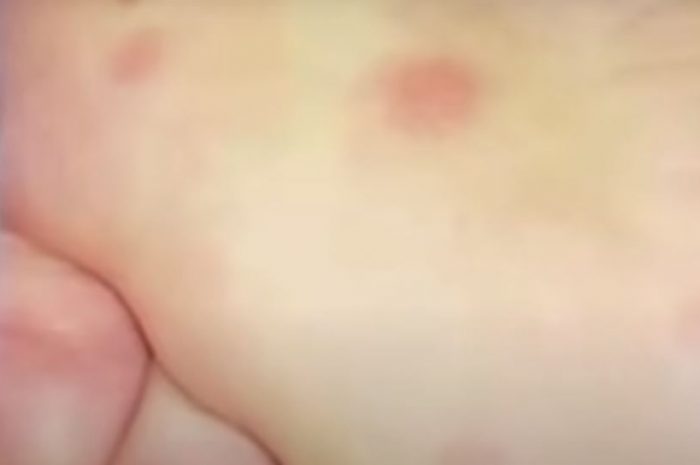 New COVID-19 symptom looks like chickenpox sores