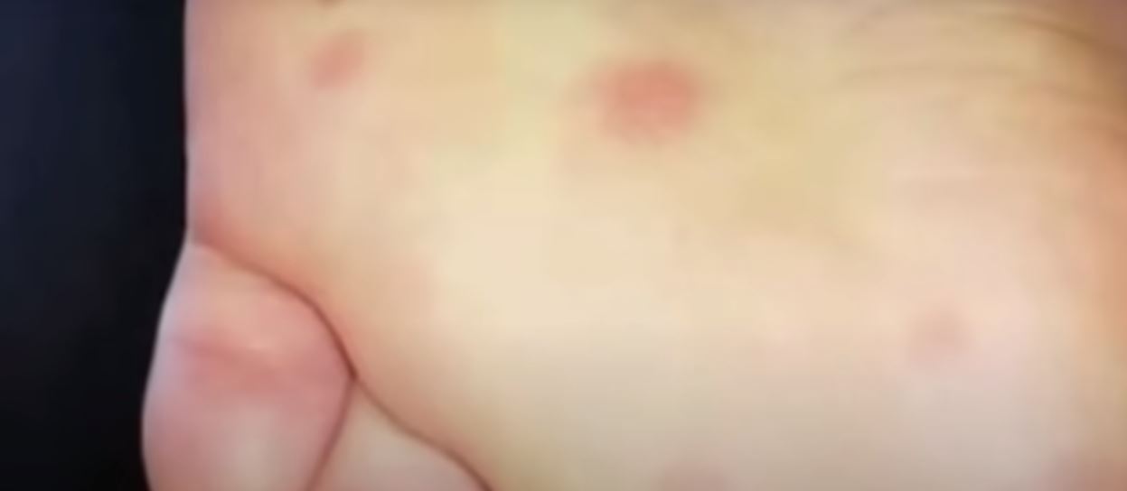 COVID-19 Chickenpox Symptom